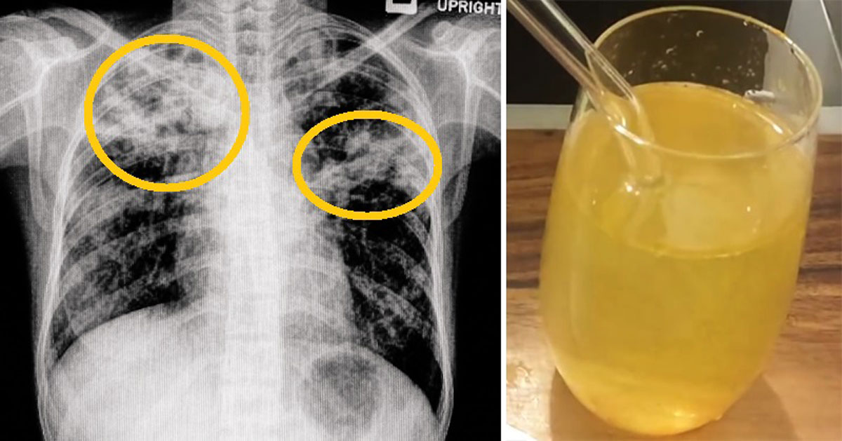5 remedios que quitan la flema y el moco rápidamente 5 remedios que quitan la flema y el moco rápidamente