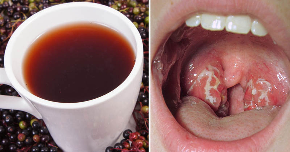 10 remedios que acaban con las infecciones de garganta por