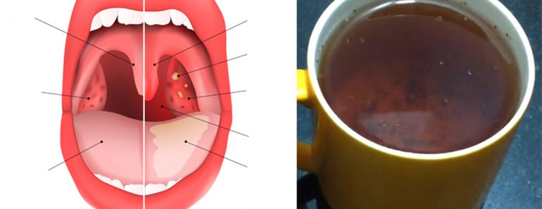 El té que cura la inflamación de garganta, las infecciones de los senos nasales y la gripe