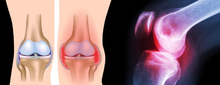 3 ejercicios simples que curan el dolor de rodilla sin cirugía o medicación