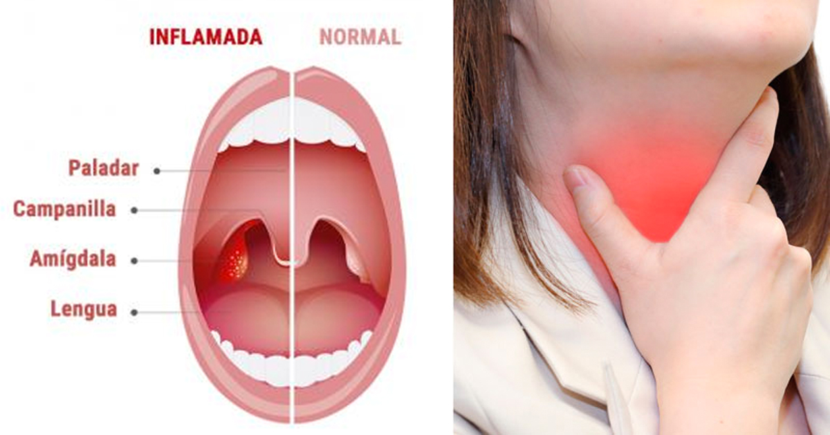 Deshágase de la amigdalitis y dolor de garganta con este Deshágase de la amigdalitis y dolor de garganta con este