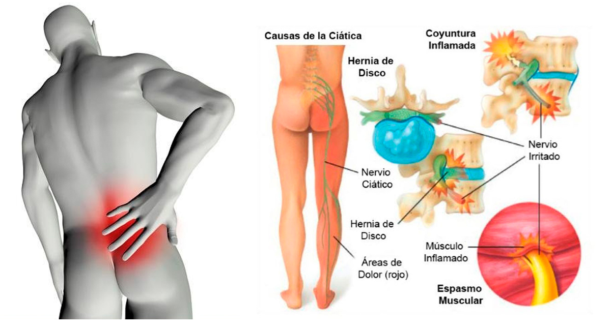 Resultado de imagen de Ciatica