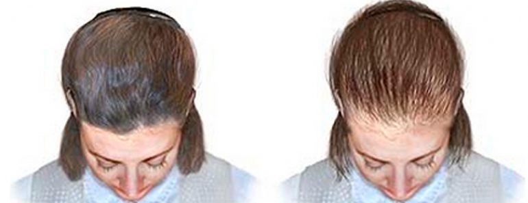 11 razones por las que tu cabello deja de crecer y se vuelve delgado