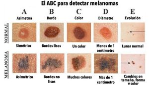 ¿Conoces la diferencia entre un lunar normal y uno CANCEROSO? Este gráfico podría salvar tu vida