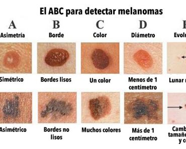 ¿Conoces la diferencia entre un lunar normal y uno CANCEROSO? Este gráfico podría salvar tu vida