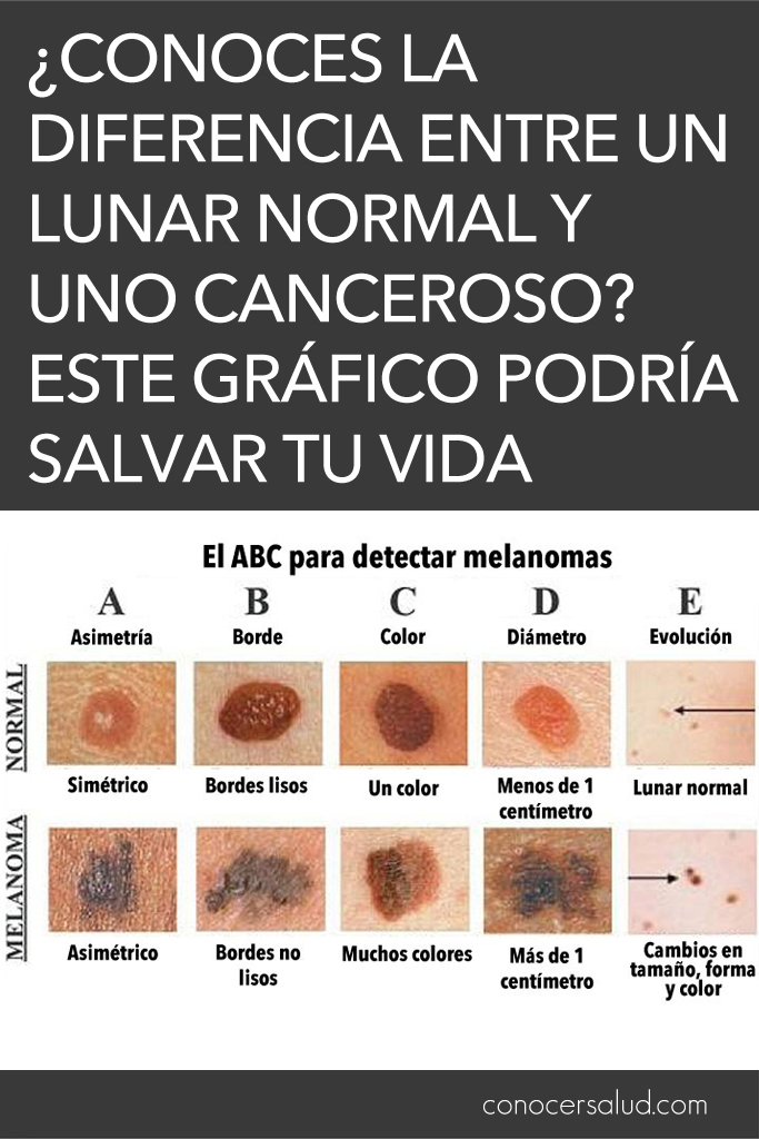 ¿Conoces la diferencia entre un lunar normal y uno CANCEROSO? Este gráfico podría salvar tu vida