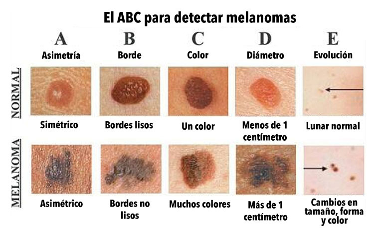 ¿Conoces la diferencia entre un lunar normal y uno CANCEROSO? Este gráfico podría salvar tu vida