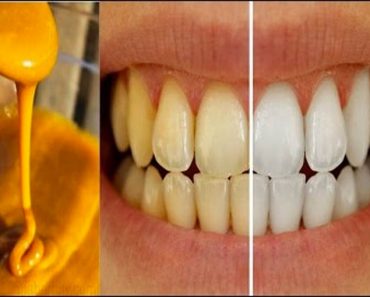 Mezcló estos tres ingredientes y los puso en sus dientes... No podrás creer el resultado