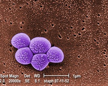 SARM: todo Lo que necesitas saber sobre esta "superbacteria"