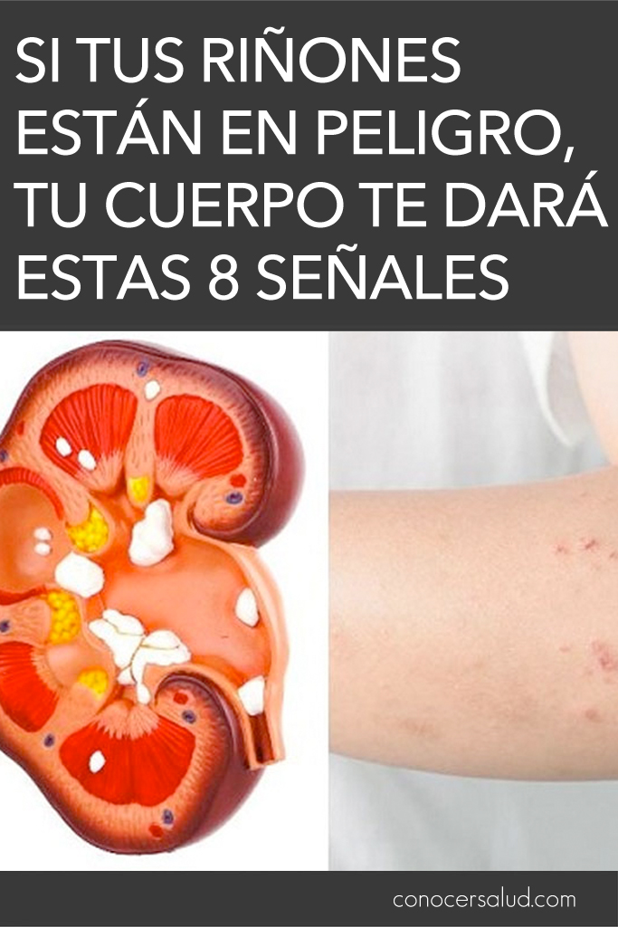 Si tus riñones están en peligro, tu cuerpo te dará estas 8 señales