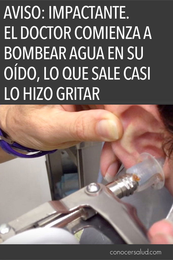 AVISO: Impactante. El doctor comienza a bombear agua en su oído, lo que sale casi lo hizo gritar