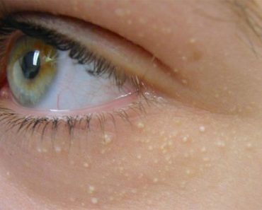 Estas manchas blancas alrededor del ojo pueden tener un aspecto inocente, pero significan algo serio