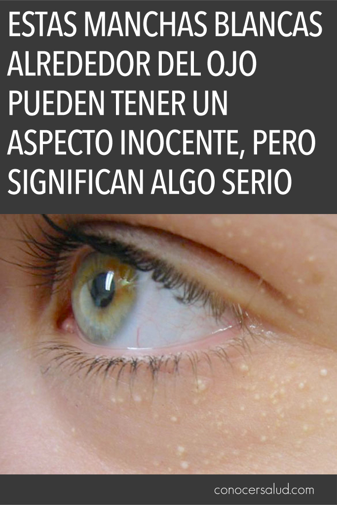 Estas manchas blancas alrededor del ojo pueden tener un aspecto inocente, pero significan algo serio