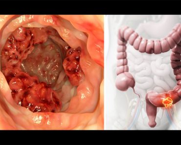 Descubren que este aceite destruye el 90% de las células del cáncer de colon en 2 días