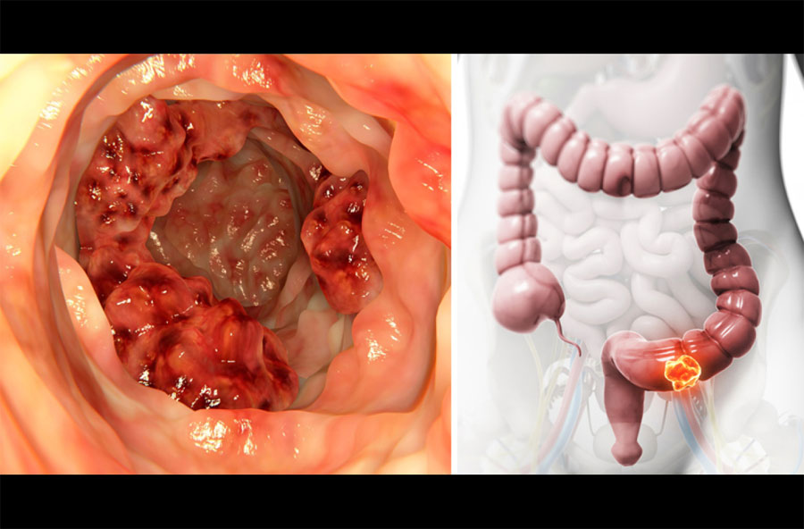 Descubren que este aceite destruye el 90% de las células del cáncer de colon en 2 días