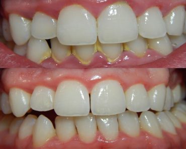 Masticar esta raíz elimina la placa, el mal olor y previene las caries