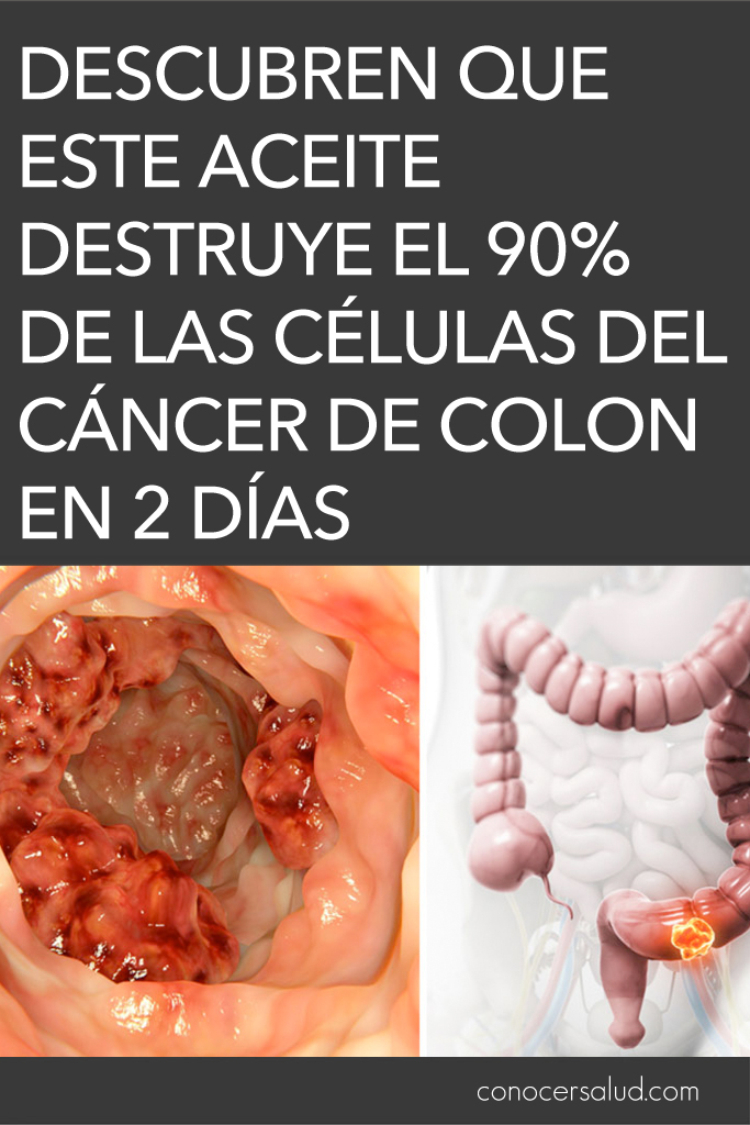 Descubren que este aceite destruye el 90% de las células del cáncer de colon en 2 días