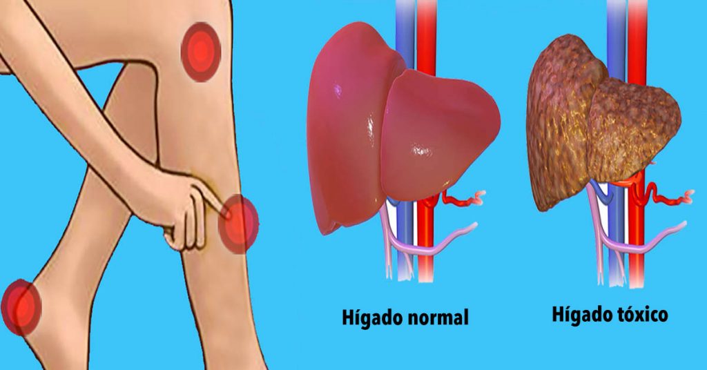 Señales de advertencia de que tu hígado está sobrecargado con toxinas