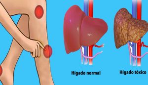 Señales de advertencia de que tu hígado está sobrecargado con toxinas