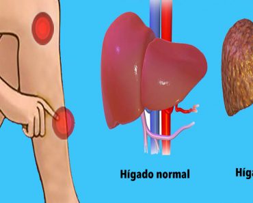 Señales de advertencia de que tu hígado está sobrecargado con toxinas