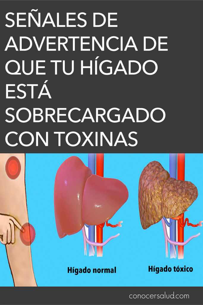 Señales de advertencia de que tu hígado está sobrecargado con toxinas