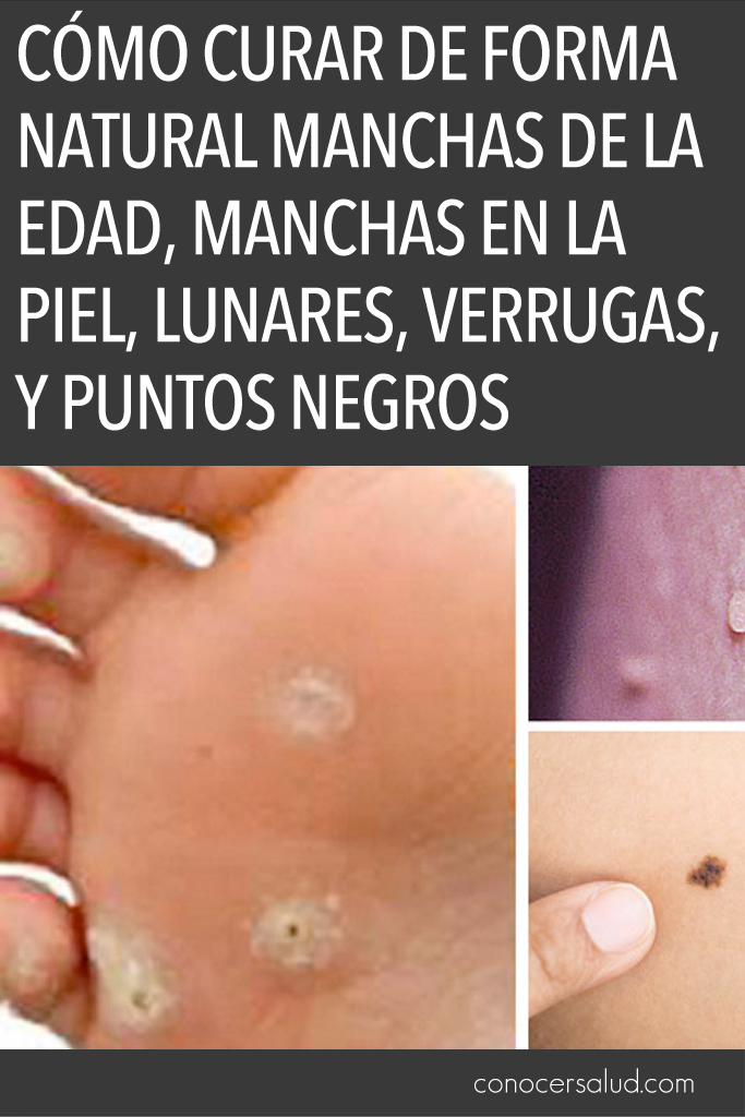 Cómo curar de forma natural manchas de la edad, manchas en la piel, lunares, verrugas, y puntos negros