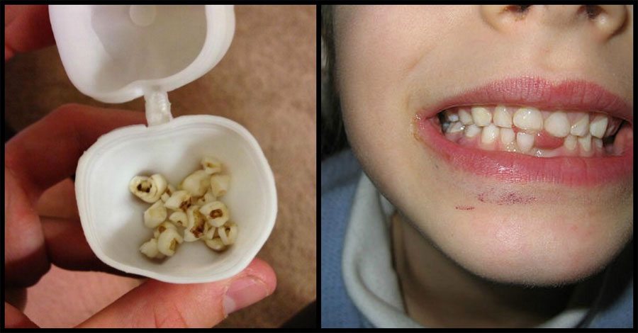 Médicos piden a todos los padres que guarden los dientes de leche de sus hijos