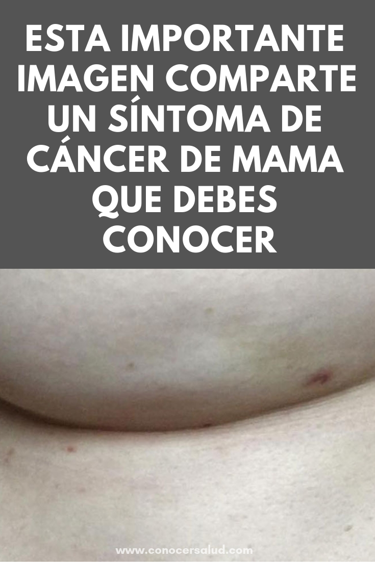 Esta importante imagen comparte un síntoma de cáncer de mama que debes conocer