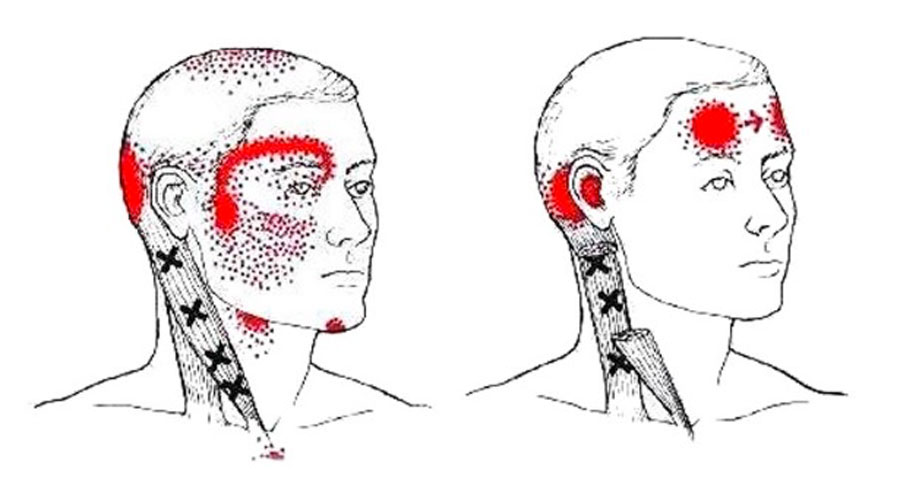 La falta de esta vitamina en tu dieta puede estar causándote migrañas y cefaleas