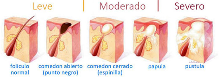 Descubre la CAUSA del acné según la zona de tu cuerpo donde aparece