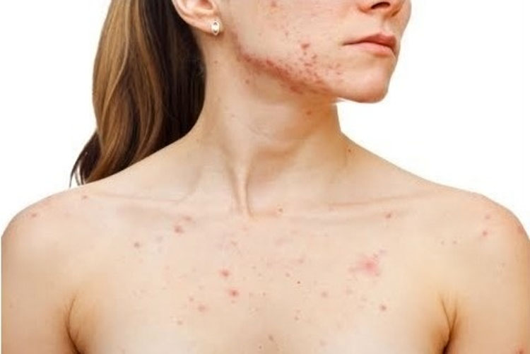 Descubre la CAUSA del acné según la zona de tu cuerpo donde aparece