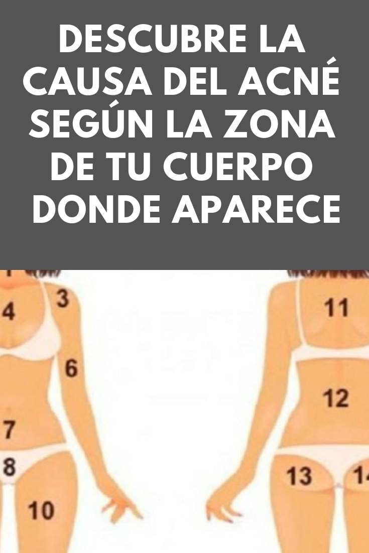 Descubre la CAUSA del acné según la zona de tu cuerpo donde aparece