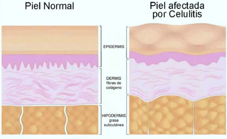 La verdad sobre lo que realmente causa la celulitis y cómo deshacerse de ella para siempre