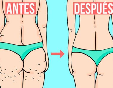 La verdad sobre lo que realmente causa la celulitis y cómo deshacerse de ella para siempre
