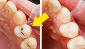 Combate y previene las caries de tus dientes desde casa y de forma natural en solo 5 pasos