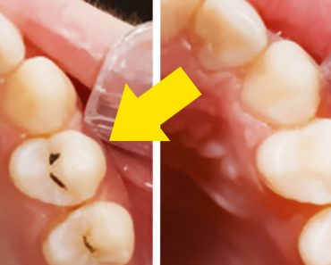 Combate y previene las caries de tus dientes desde casa y de forma natural en solo 5 pasos