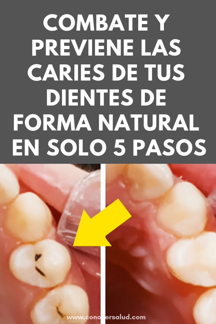 Combate y previene las caries de tus dientes desde casa y de forma natural en solo 5 pasos