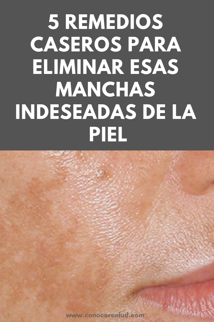 5 remedios caseros para eliminar esas manchas indeseadas de la piel