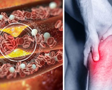 6 señales que muestran que quizás tengas un coágulo de sangre
