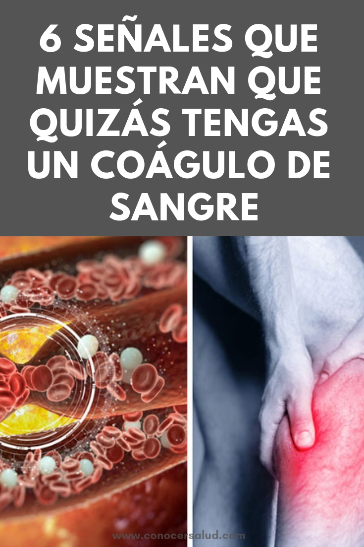 6 señales que muestran que quizás tengas un coágulo de sangre