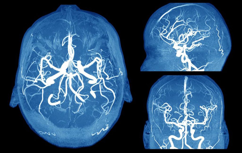 Cómo detectar un aneurisma cerebral antes de que sea demasiado tarde