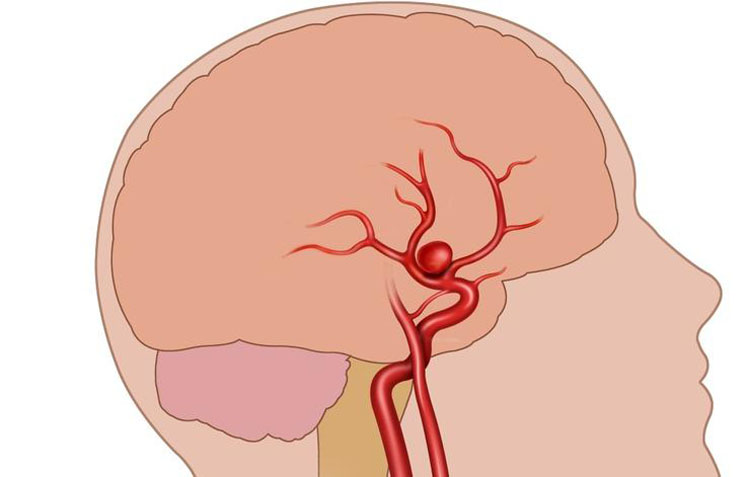 Cómo detectar un aneurisma cerebral antes de que sea demasiado tarde