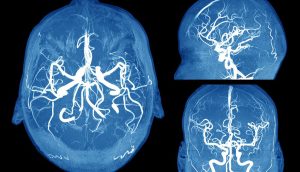 Cómo detectar un aneurisma cerebral antes de que sea demasiado tarde