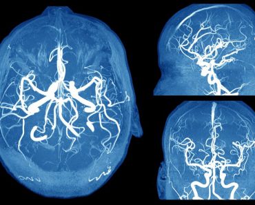 Cómo detectar un aneurisma cerebral antes de que sea demasiado tarde