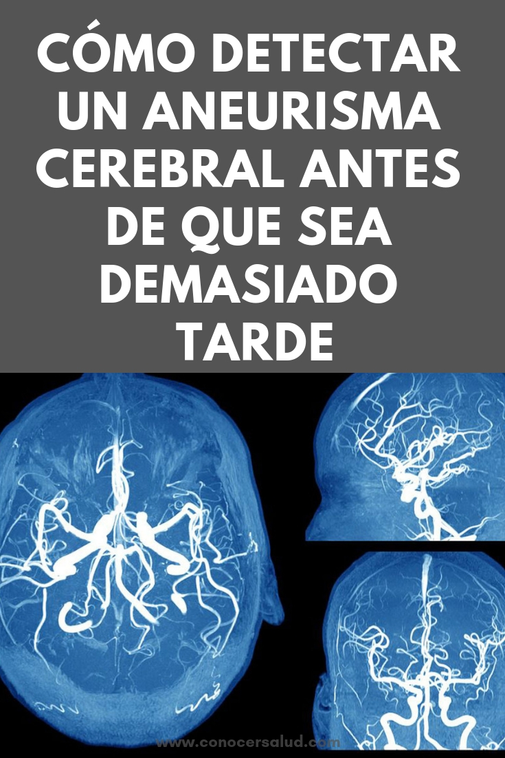 Cómo detectar un aneurisma cerebral antes de que sea demasiado tarde