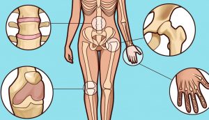 ¿Sospecha que tiene artritis? Cómo detectar los primeros síntomas