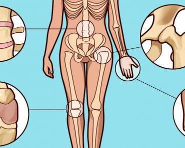 ¿Sospecha que tiene artritis? Cómo detectar los primeros síntomas