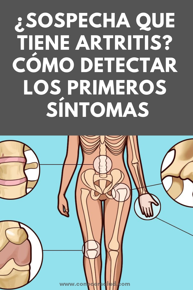 ¿Sospecha que tiene artritis? Cómo detectar los primeros síntomas