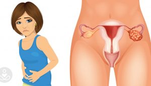 4 primeros síntomas de cáncer de ovario que cada mujer necesita saber