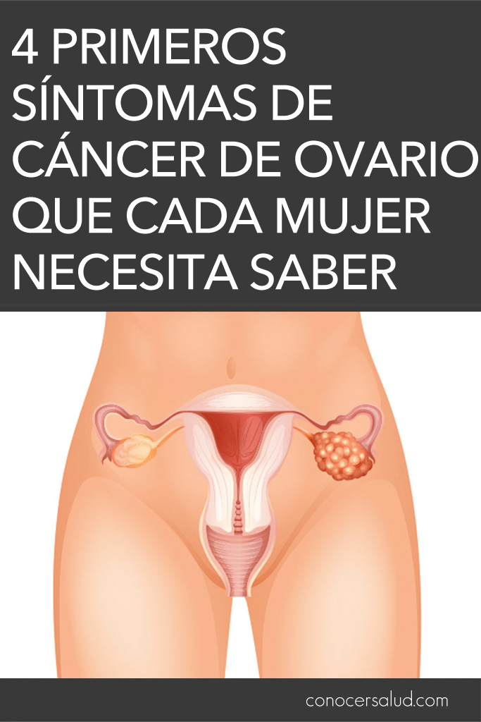 4 primeros síntomas de cáncer de ovario que cada mujer necesita saber